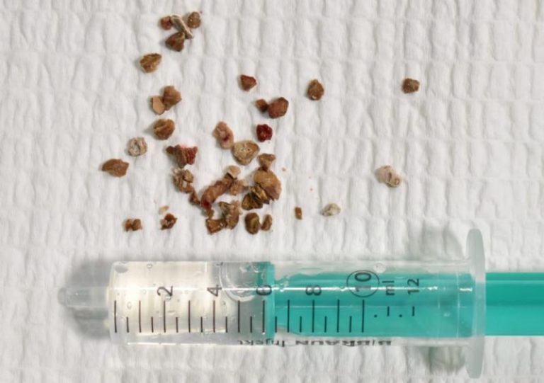 Más de dos millones de personas en España tienen cálculos renales