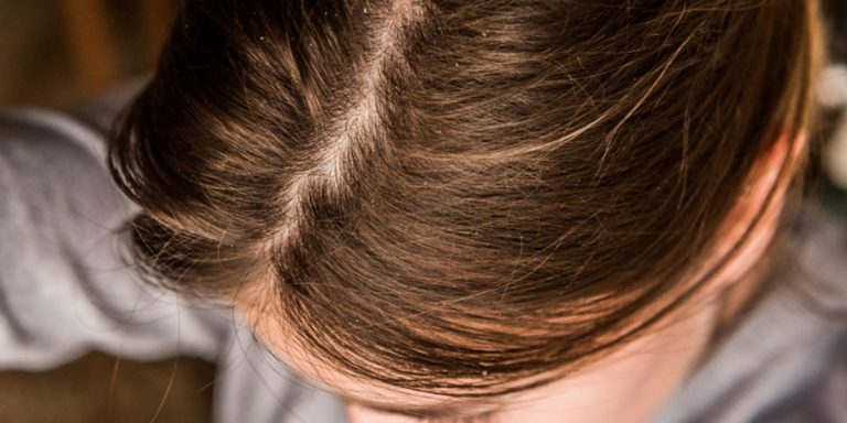 Esto es lo que tienes que hacer para terminar con la caspa