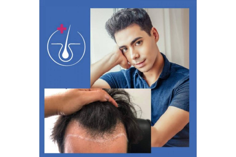 La Clínica Médica Capilar garantiza el crecimiento de los implantes y ofrece una atención personalizada postoperatorio