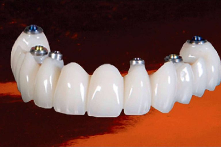 La clínica Dental Implantologie ofrece laboratorio propio para el servicio de estética dental y ortodoncia invisible