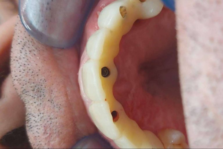 Llevar a cabo implantes dentales en un día es posible gracias a la tecnología digital de Dentinova