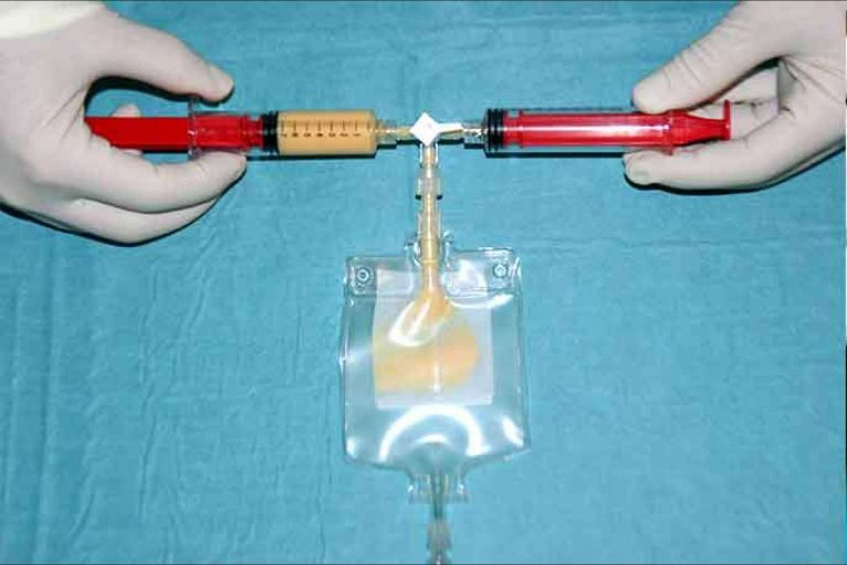 Dr. Jorge Planas y su técnica Nanofat para favorecer el rejuvenecimiento de una forma no invasiva