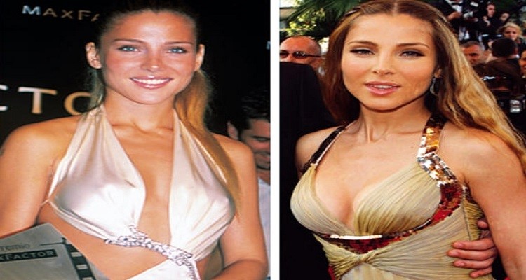 Famosas que se han operado los pechos