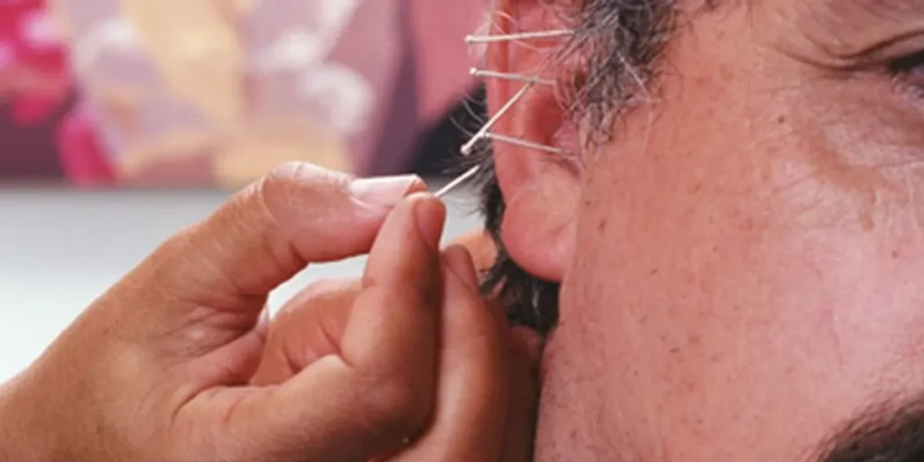 ¿Por qué se realiza la acupuntura?