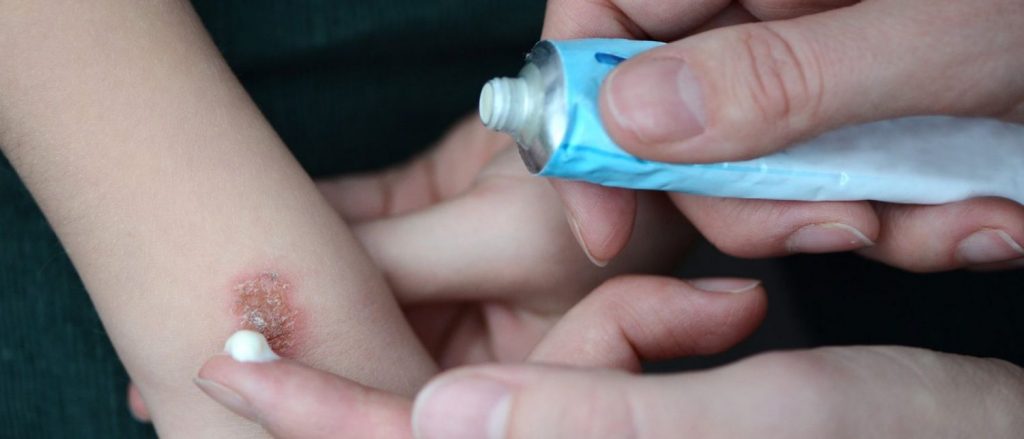 Esto es lo que debes hacer si te salta aceite hirviendo 28 Crema especial