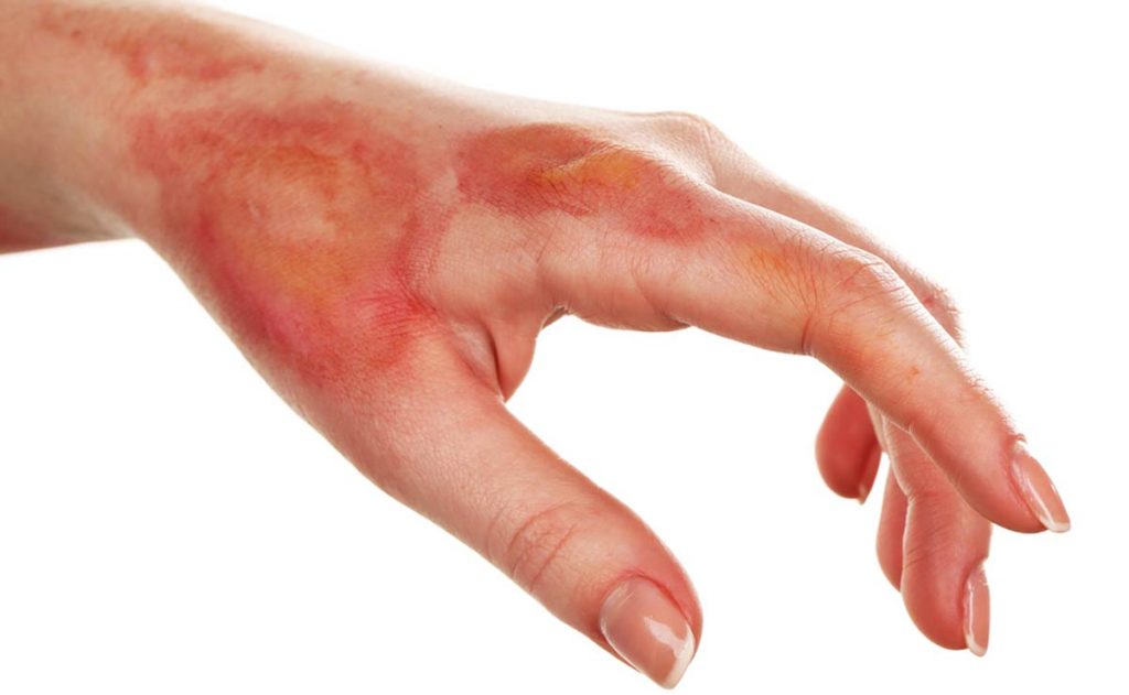 Esto es lo que debes hacer si te salta aceite hirviendo 27 Difícil acceso a la quemadura