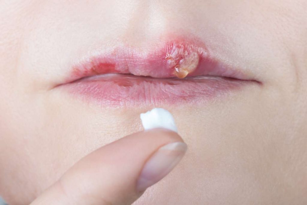Herpes labial