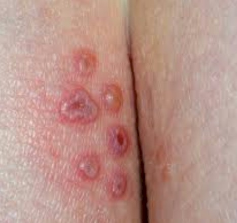 ¿El herpes genital puede manifestarse varias veces?