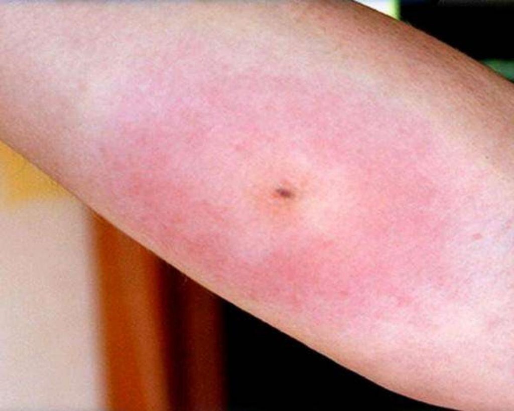 Qué hacer si te pica una araña 141 ¿Qué hacer en casa si te pica una araña?