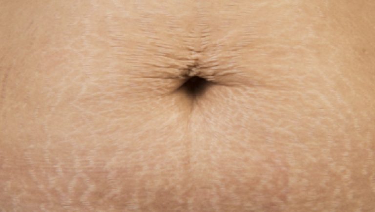 Conoce la última tecnología para eliminar las estrías