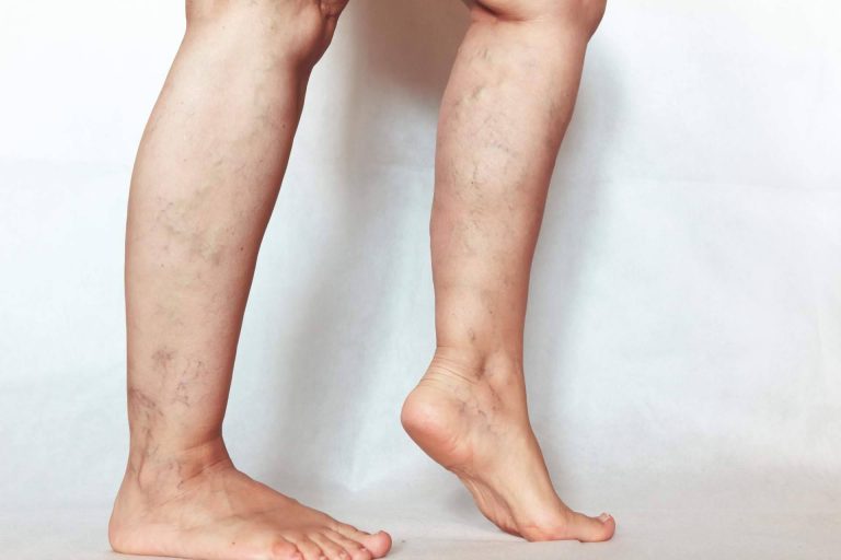 La fisioterapia ayuda a mejorar los síntomas de las patologías del sistema vascular periférico