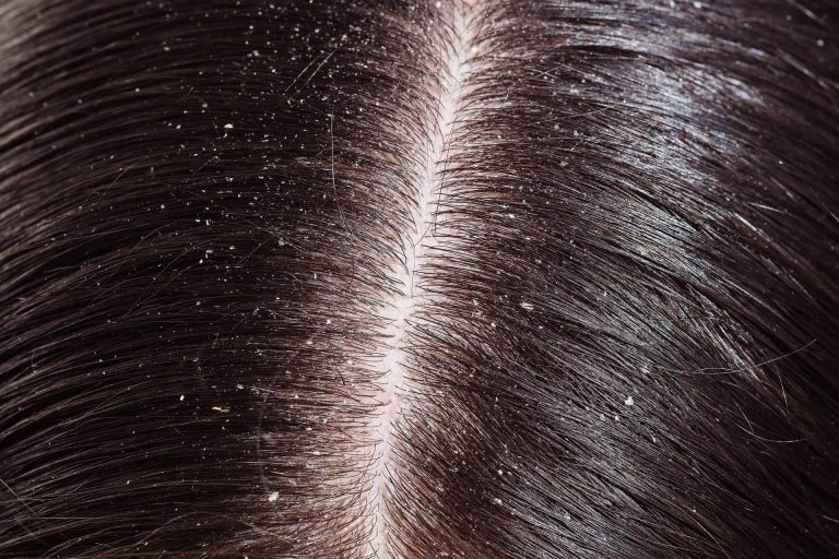 El champú especial para calmar la seborrea