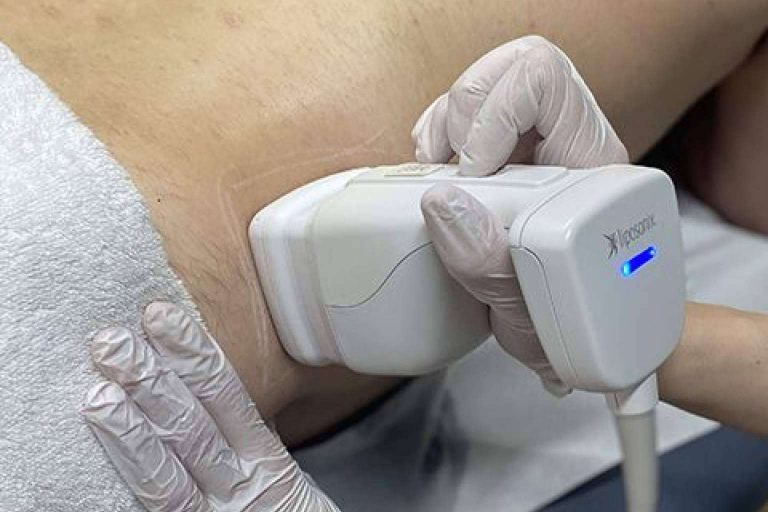 Liposonix, un tratamiento reductor de la grasa localizada sin dolor ni cirugía