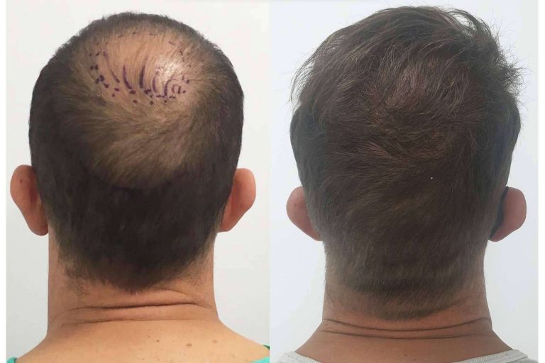 La inteligencia artificial se consolida como el futuro del injerto capilar