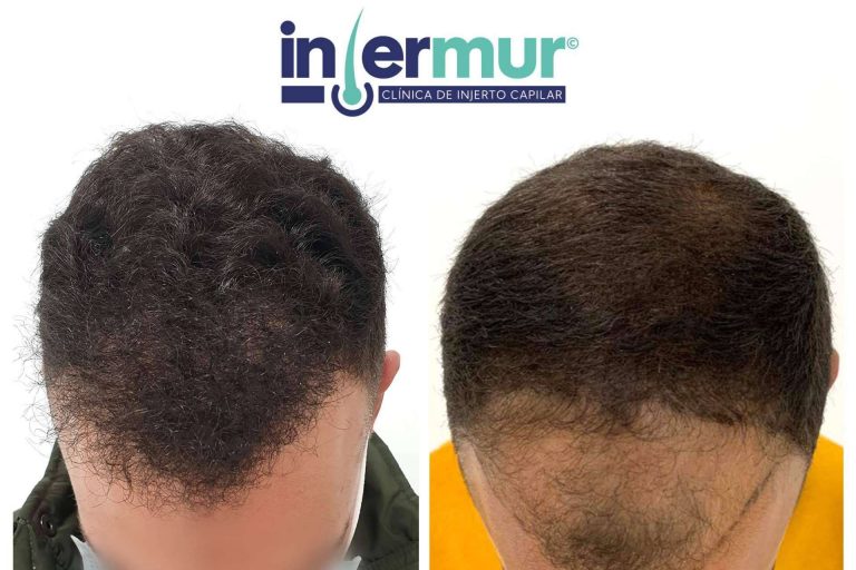 ¿Cómo se puede combatir la alopecia androgénica?