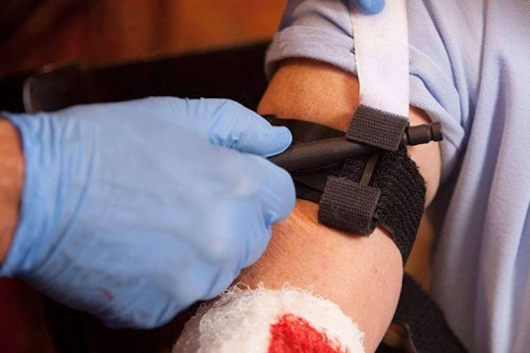 ¿Cuándo y cómo se debe hacer un torniquete?