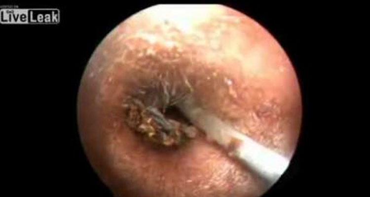 Parásitos que ahora están en tu cuerpo y no lo sabes