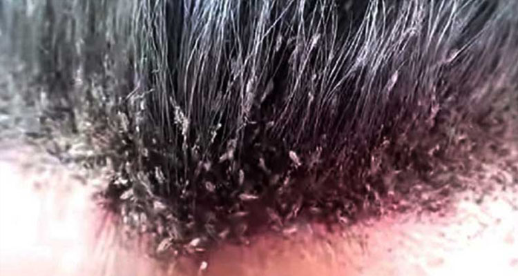 Parásitos que ahora están en tu cuerpo y no lo sabes