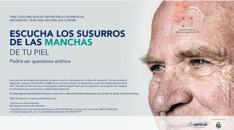 El 28,6% de la población española de más de 45 años padece queratosis actínica, la afección precancerosa más común