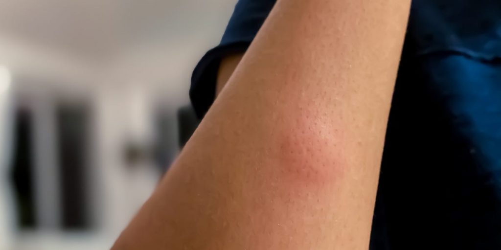 ¿Es cierto que algunos individuos llaman más la atención a los mosquitos que otros?