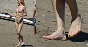 Famosos con deformidades físicas nunca notadas