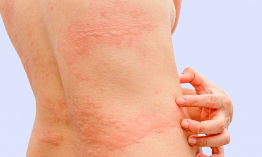 ¿Cuál puede ser la causa de la aparición de una urticaria?