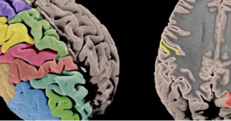 Un investigador español traza un mapa de cómo cambia el cerebro durante el tratamiento de la depresión
