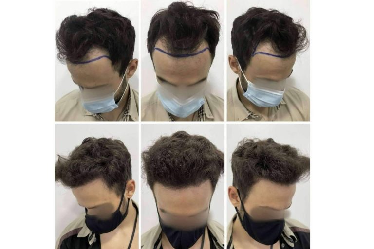 El Dr. Bruno Jacobovski expone los efectos secundarios de un injerto capilar