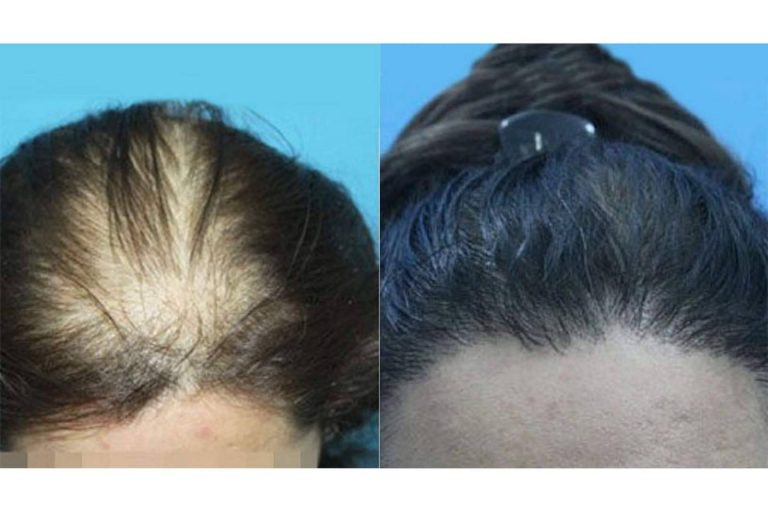 Una de las clínicas de referencia de injerto capilar en Madrid, Innovación Capilar