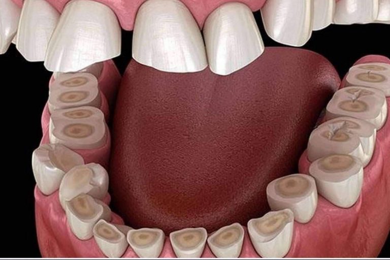 ¿Es posible calmar los síntomas del bruxismo mediante la aplicación de botox?