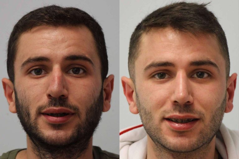 En Valladolid y Santander está disponible el avance médico de la rinoplastia ultrasónica