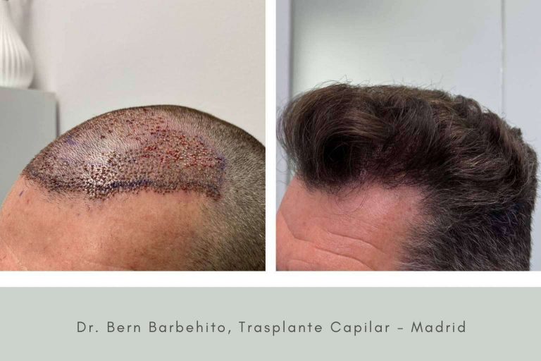 Todo lo que hay que saber acerca del postoperatorio de la cirugía capilar, de la mano del Doctor Bern
