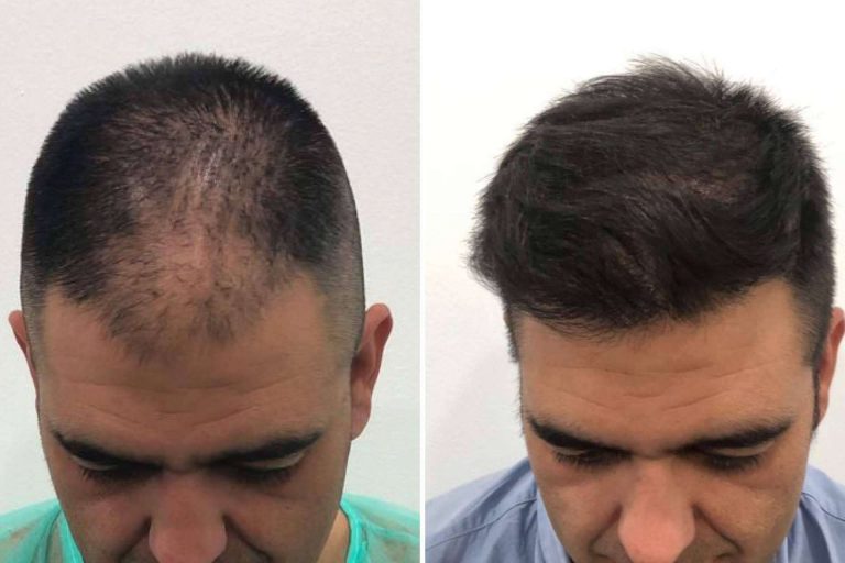 Los beneficios de la exclusiva técnica META FUE 3 Dual para el injerto capilar en Injermur y cómo funciona