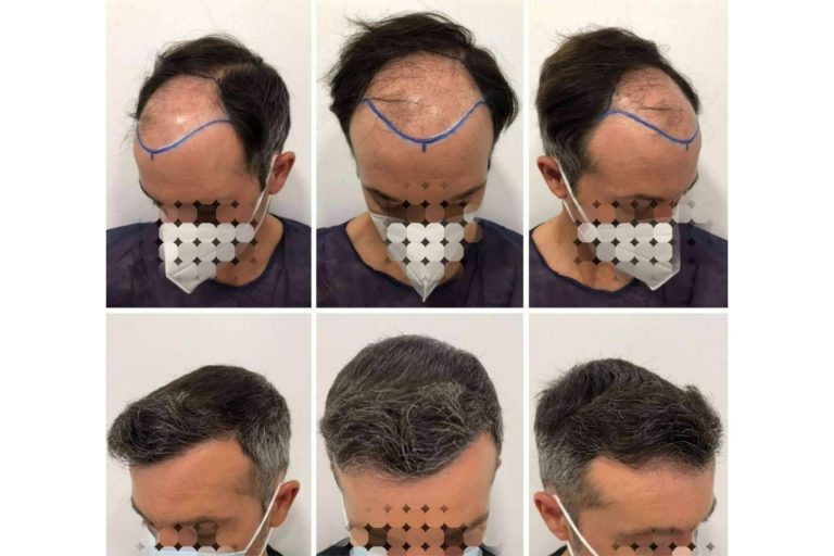 ¿Cómo es la evolución del injerto capilar día a día después de someterse a un implante capilar?