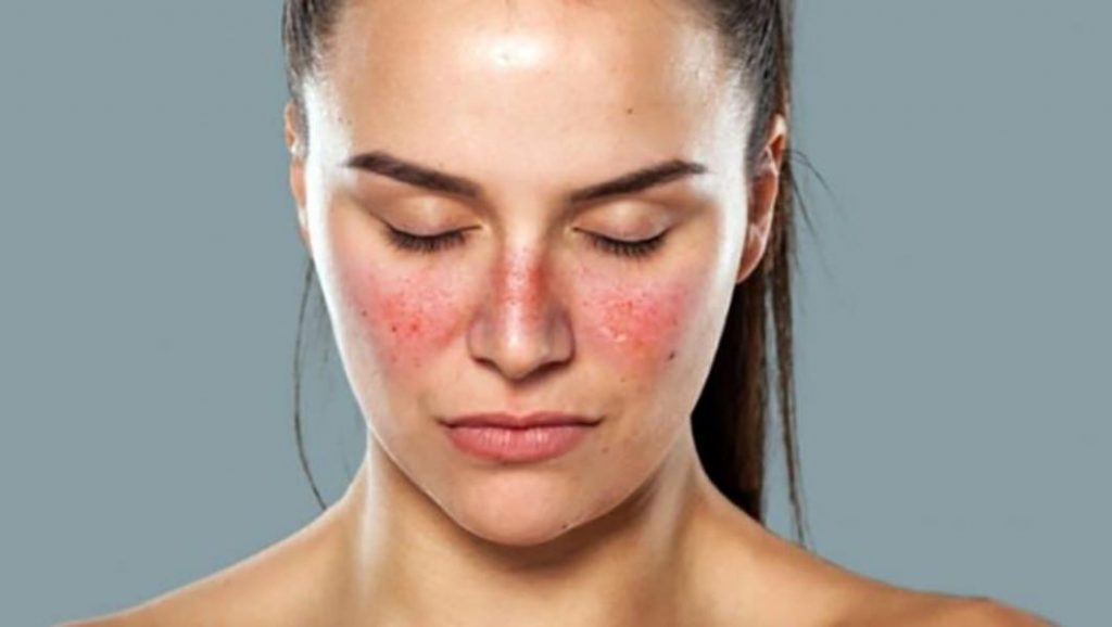 Síntomas: erupción malar