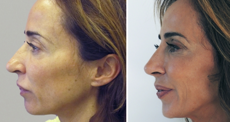 El top de las mejores rinoplastias de famosas españolas