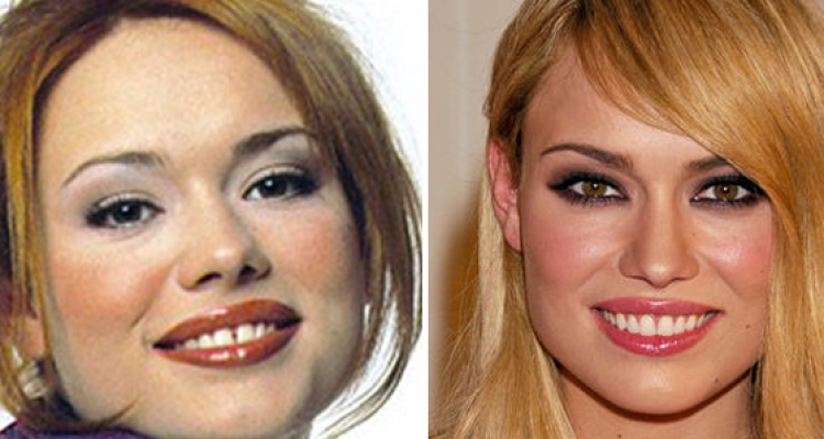 El top de las mejores rinoplastias de famosas españolas