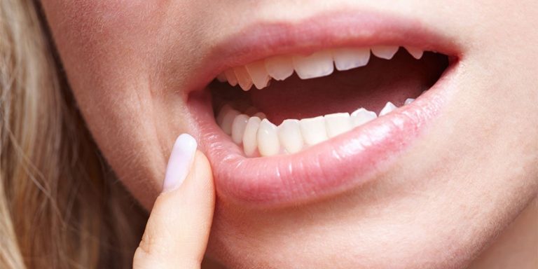 La llagas en la boca que necesita una visita urgente al médico