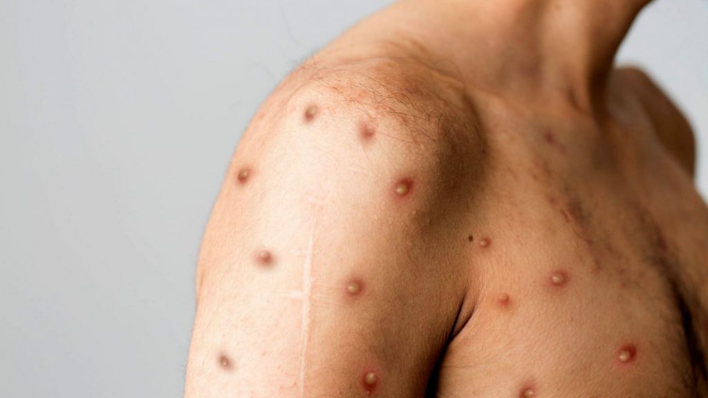 Contagio hombre/animal