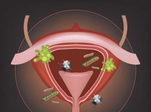 Cómo quitar la infección de orina rápido 1 Cómo quitar la infección de orina rápido