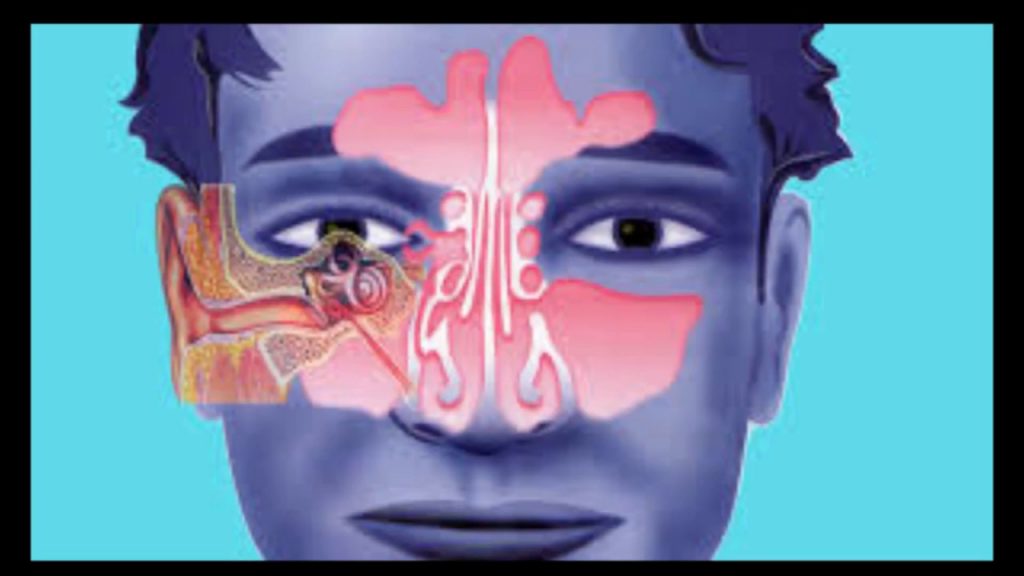 ¿Cuáles pueden ser otras causas de que los oídos se taponen?