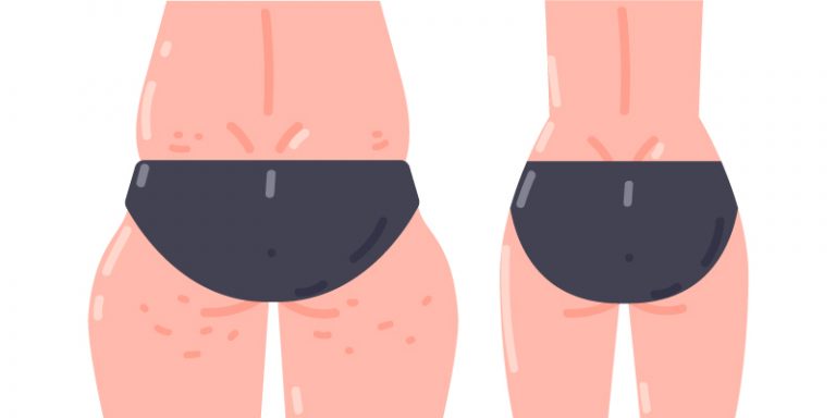 El truco para eliminar la grasa de las caderas