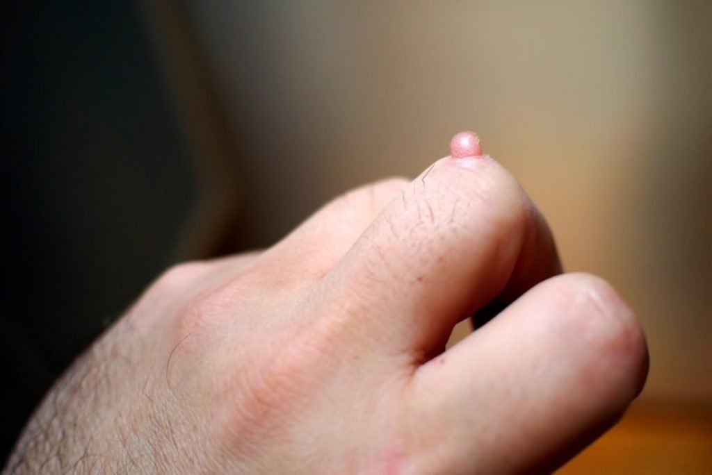 ¿Cuál es la causa de las verrugas?