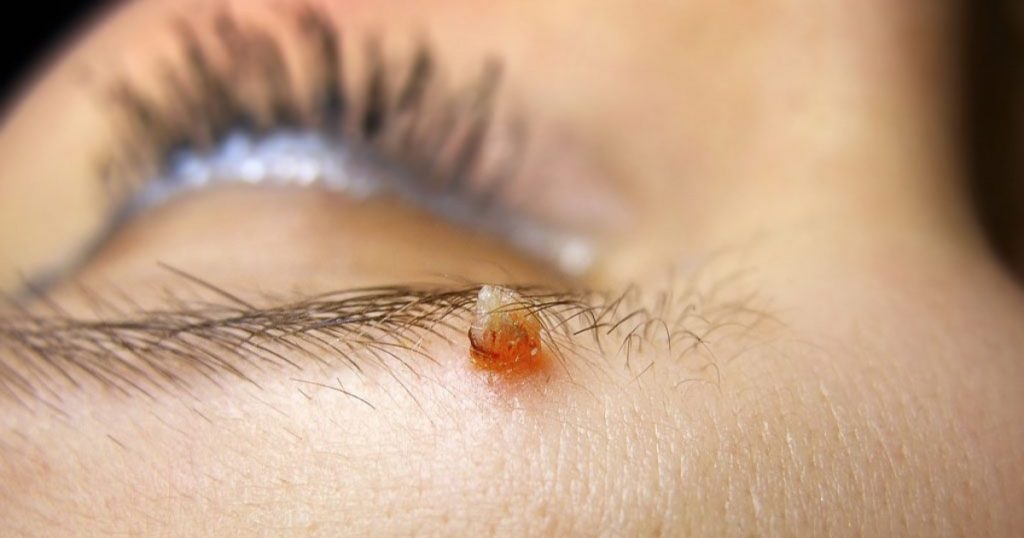 ¿Las verrugas comunes entrañan algún riesgo?