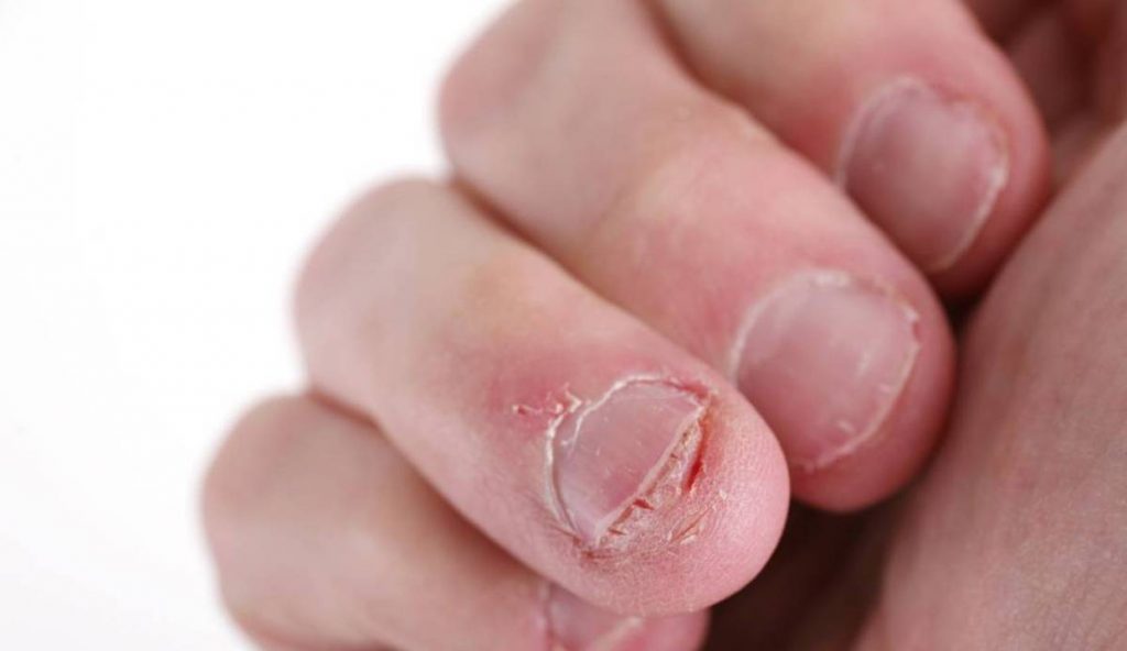 ¿Quiénes son más propensos a sufrir de onicofagia?