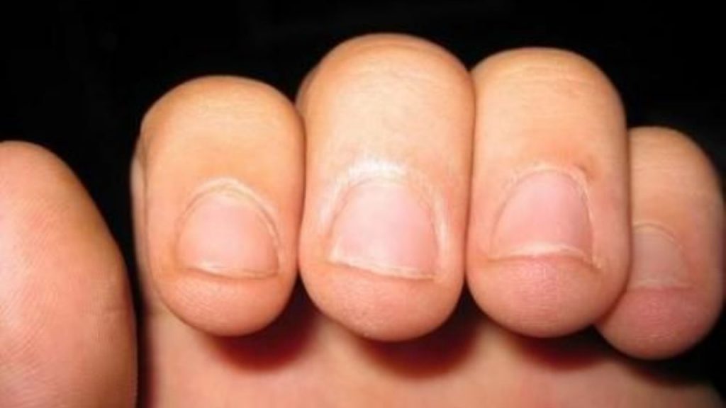 ¿Cuáles son los motivos por los que nos mordemos las uñas?