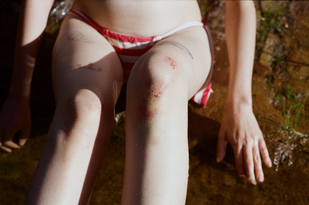 Avisos que te dicen que tienes el hígado dañado 43 Moretones en tu cuerpo y el hígado