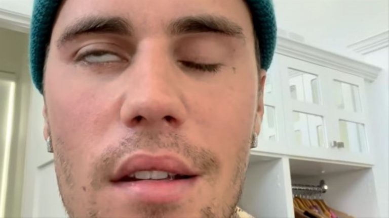 Qué es el síndrome de Ramsay Hunt