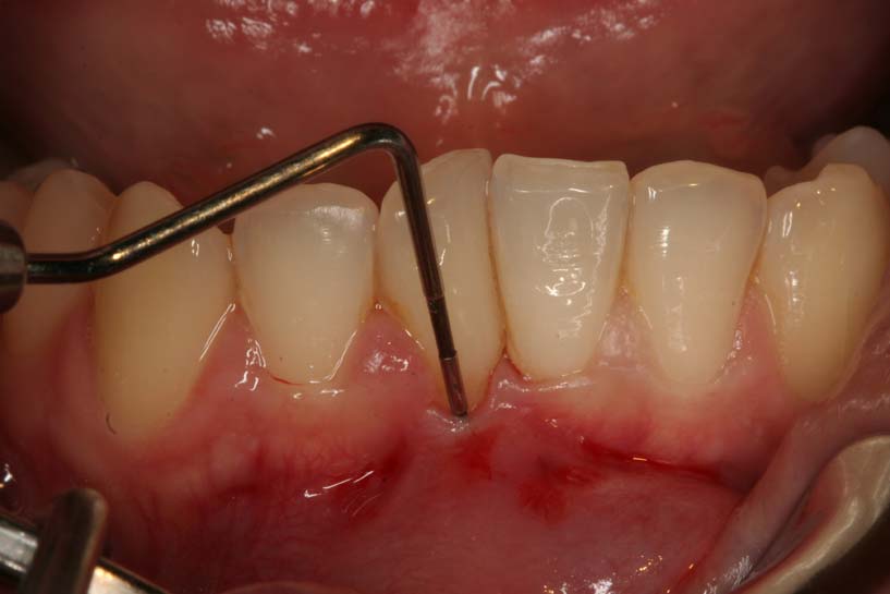 Qué es la piorrea 1 ¿Qué es la piorrea?