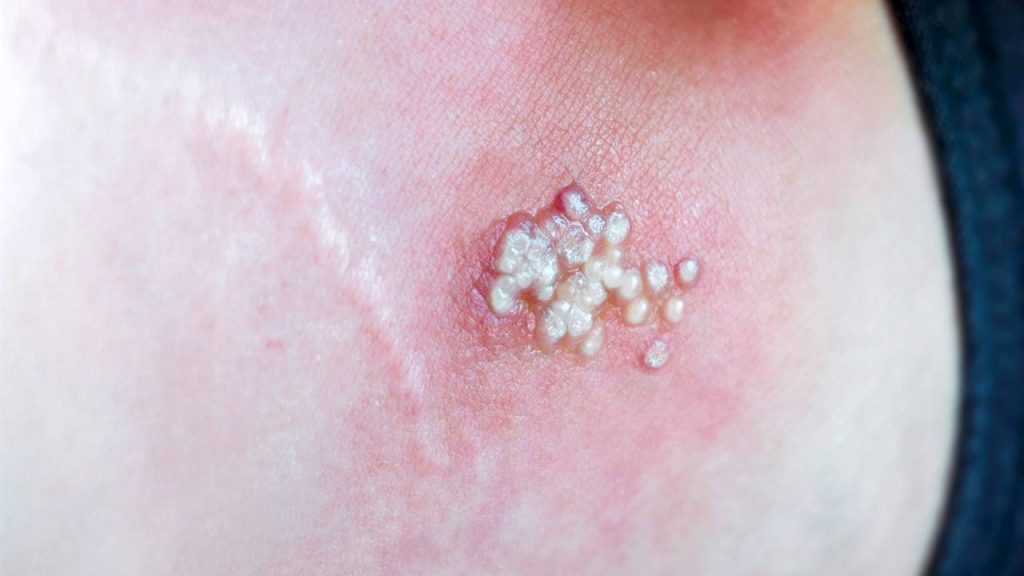 ¿La gente puede morir de viruela del mono?